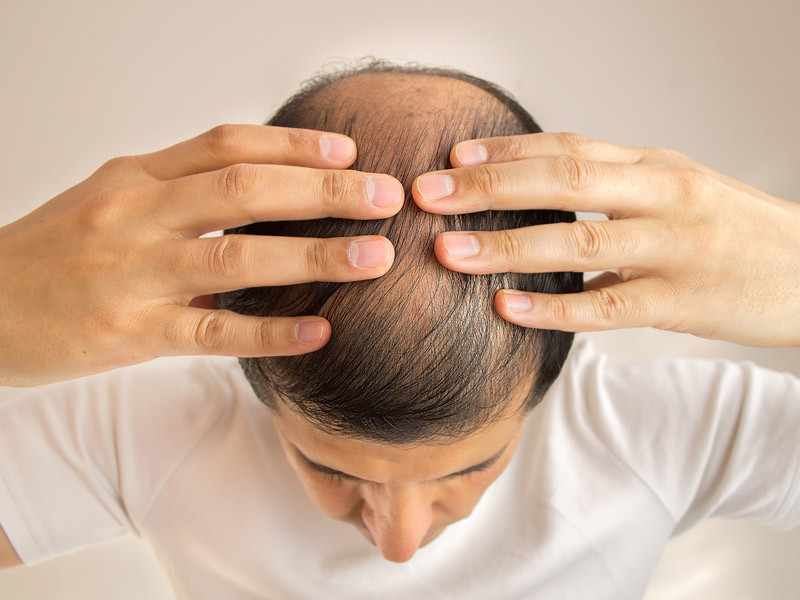 Caida Del Cabello Cuestion De Vanidad O Salud