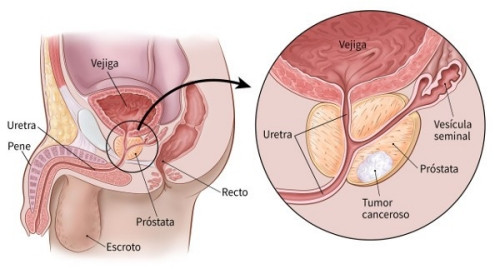 prostata preventiva A prostatitis urethritis tablettái