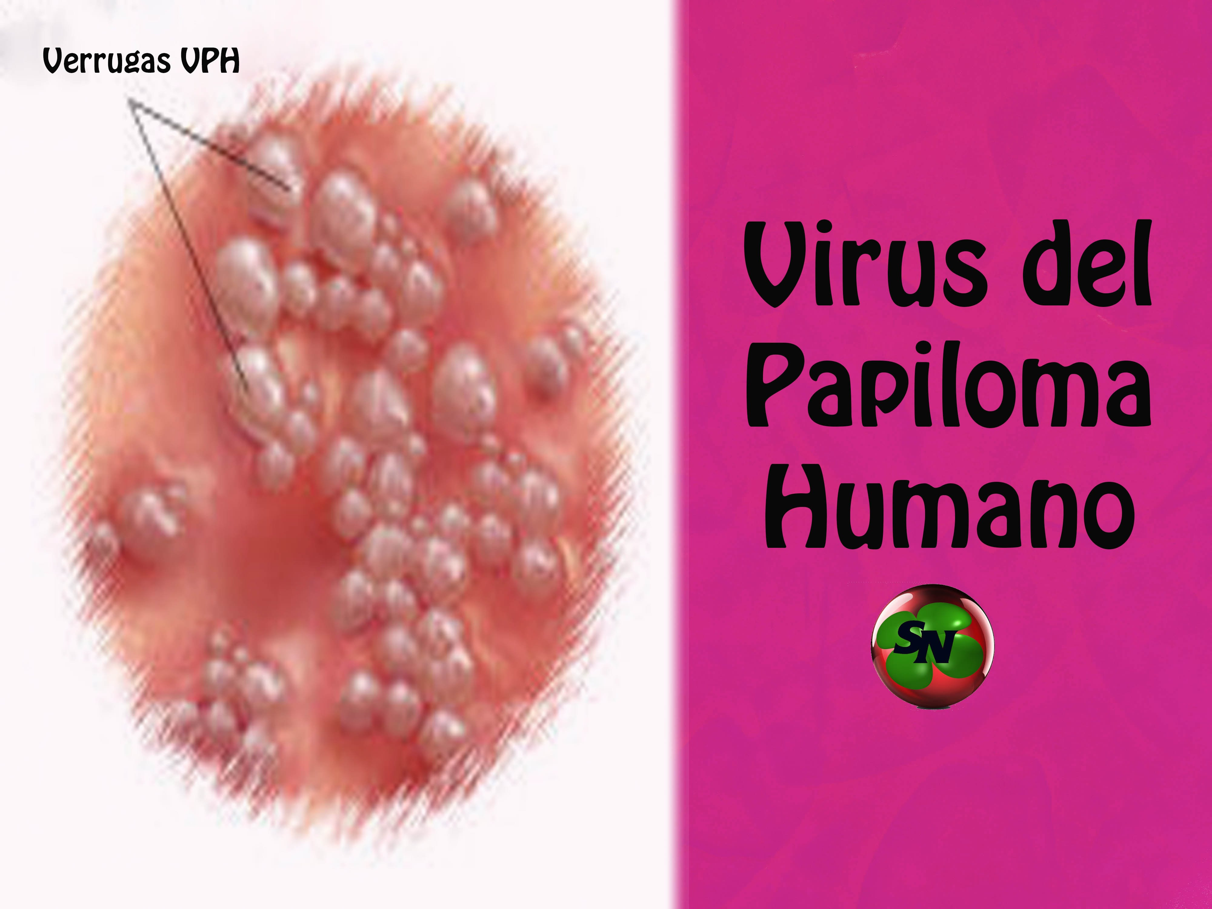 que es la papiloma virus