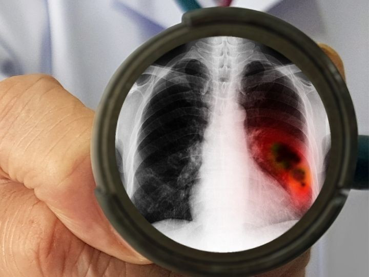 Cancer de pulmon un mal que no solo afecta a fumadores