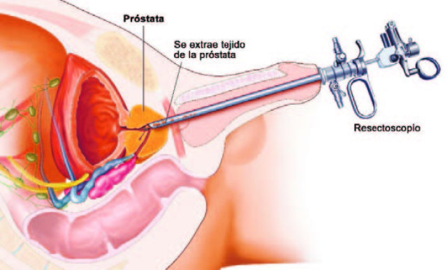 hombres masterbating cáncer de próstata