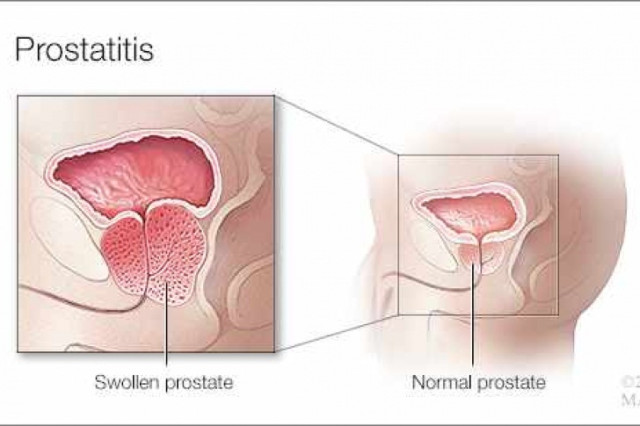 Prostatitis és vese