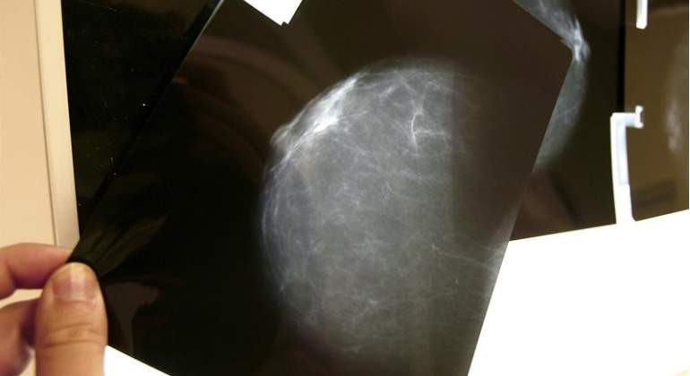 Cancer mama radiografia 770x420 efe