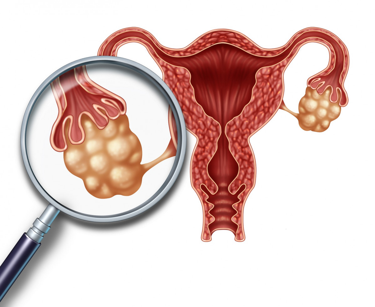 El cu00e1ncer de ovario es la primera causa de muerte por cu00e1ncer del sistema reproductor femenino.