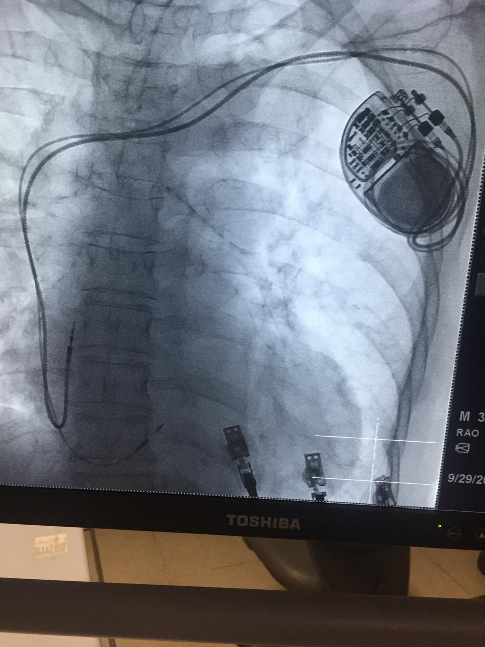 Centro Cardiovascular HOMS coloca primer implante con estimulaciu00f3n en el has de His en la regiu00f3n del Cibao.1