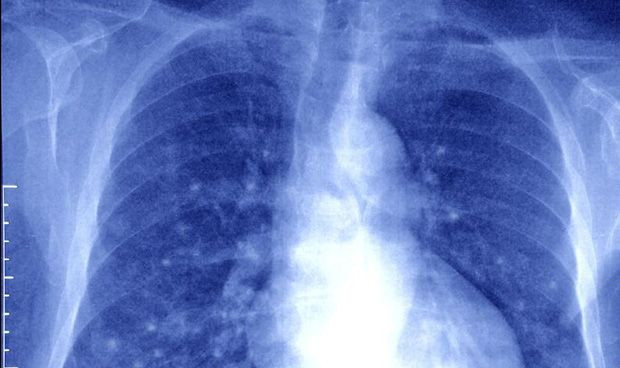 Una nueva tecnica permite el diagnostico precoz del cancer de pulmon 4156 620x368