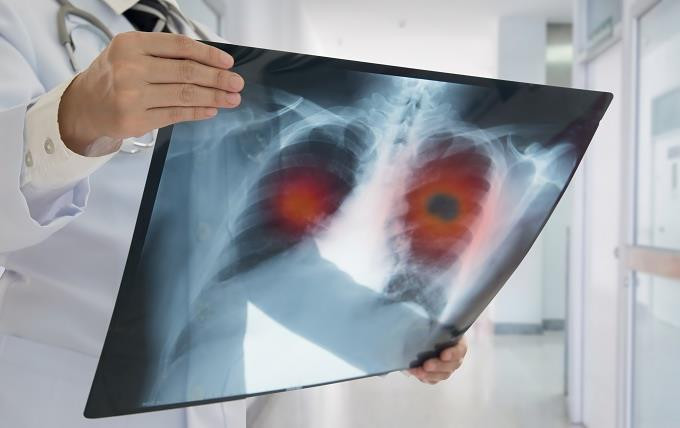 Sistema computacional ayudaria a detectar cancer de pulmon