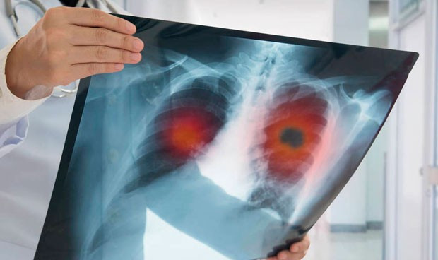 Un algoritmo de google detecta el cancer de pulmon mas rapido que un medico 6366 620x368