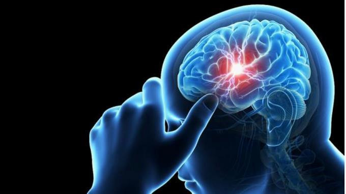 El vih puede afectar el cerebro a pesar del tratamiento antirretroviral