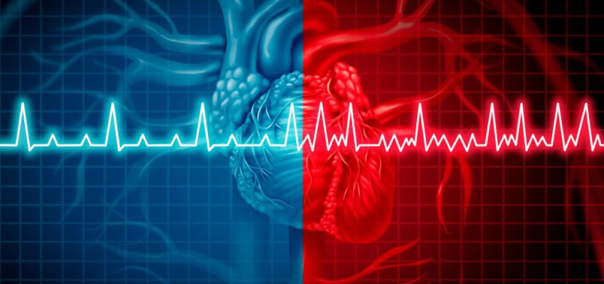 Irhythm y verily se asocian para el diagnostico de fibrilacion auricular silenciosa