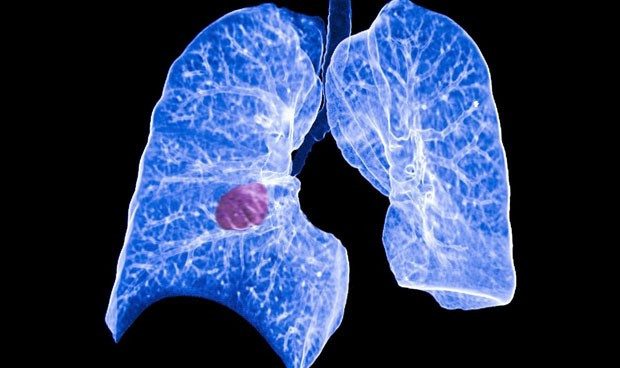 Descubren una via del cancer de pulmon para hacerse resistente 7963 620x368