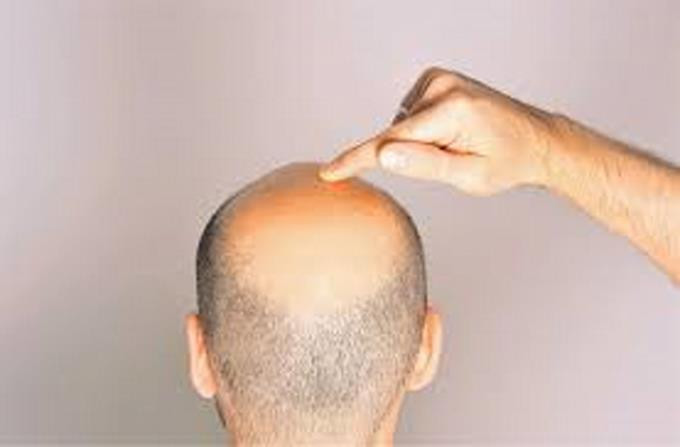 La perdida de cabello tambien es culpa de la contaminacion