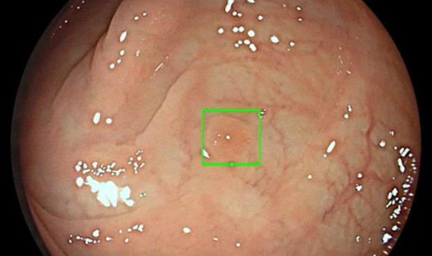 Medtronic lanza la primera inteligencia artificial para colonoscopia  3005 620x368