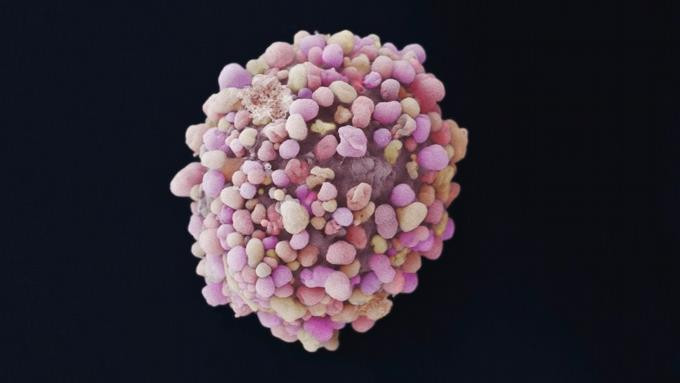 Hallan dos nuevos farmacos para cancer de mama resistente en metastasis