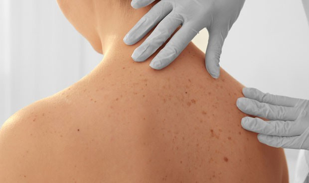 Guia clinica melanoma dermatologos aedv 7480 620x368