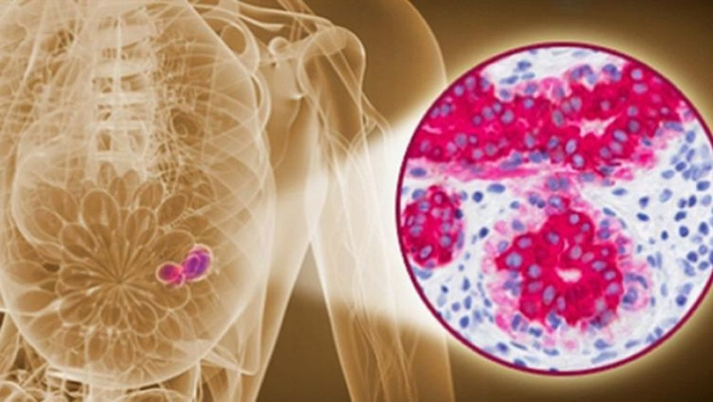 Una biopsia de mama guiada por imagen es capaz de predecir el cancer residual 15 1000x564