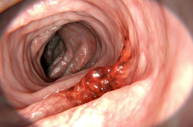 Colorectal cancer 