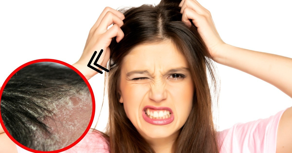 1 causas comezon cuero cabelludo principal