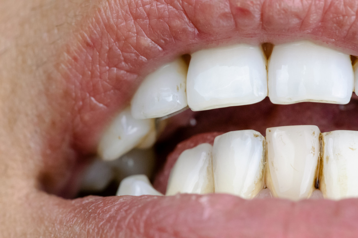 Por que salen manchas en los dientes02