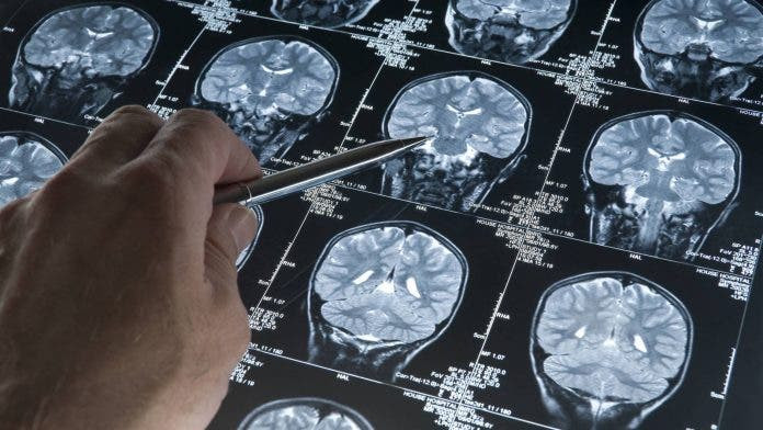 La sorprendente razon detras del alzheimer un estudio lo cambia todo 696x392 1