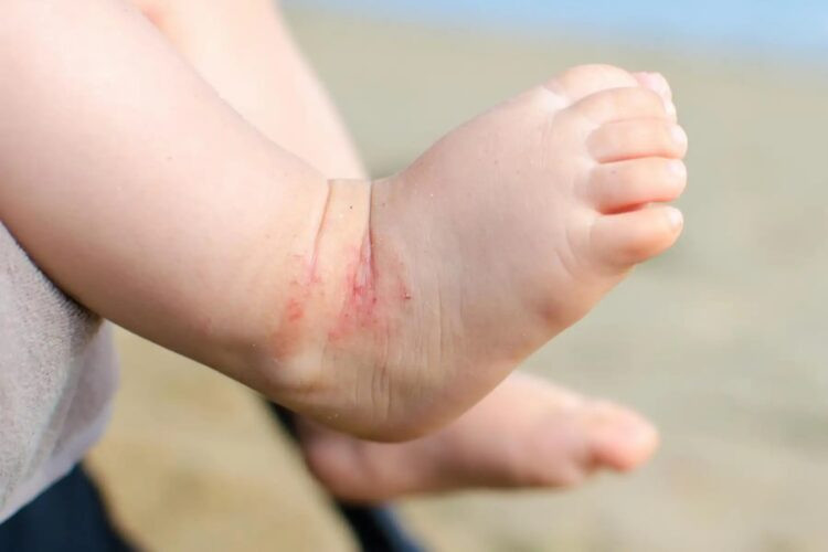 Dermatitis atopica 750x500
