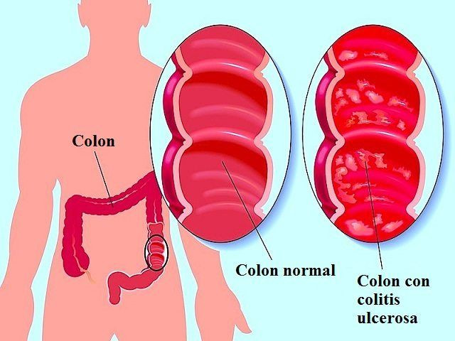 Colitis ulcerosa