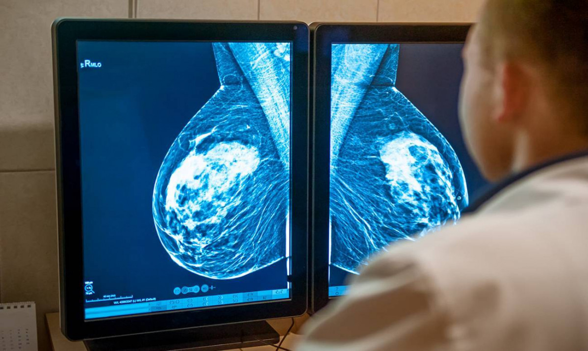 Primer test genomico para el tratamiento personalizado del cancer de mama HER2