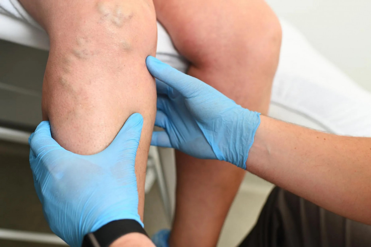 Varices piernas 2720745ASDFGH