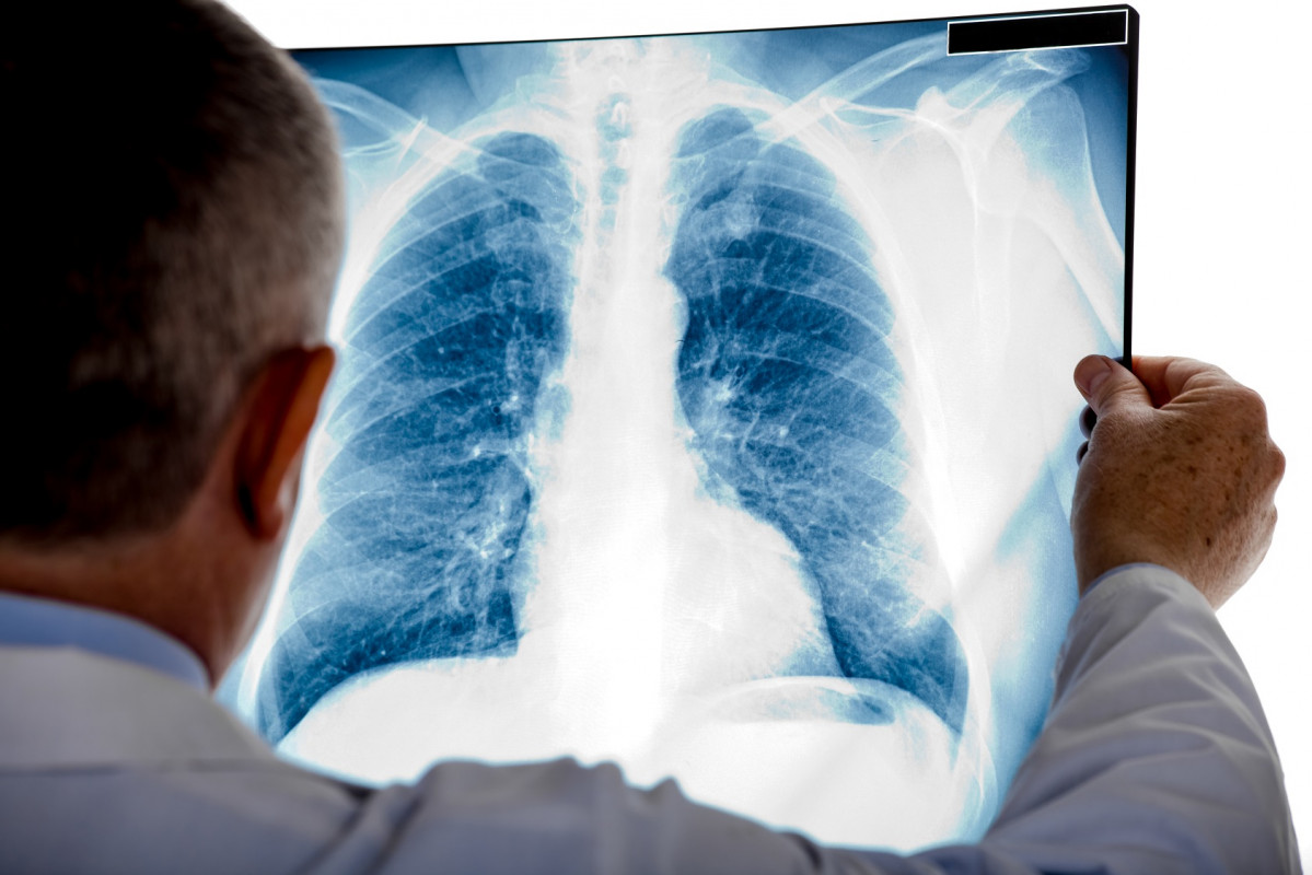 Diagnostico cancer de pulmon