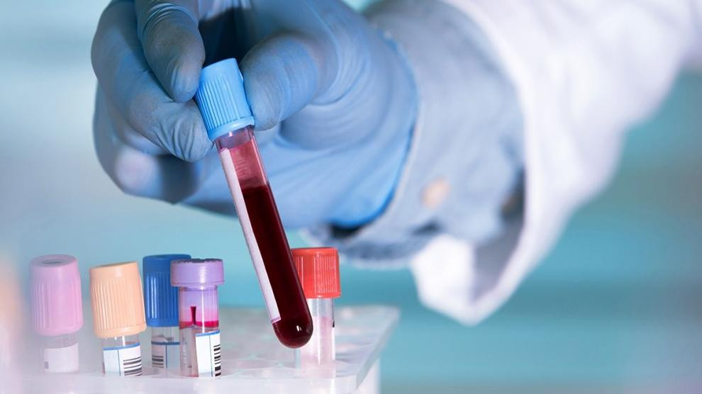 Un simple analisis de sangre basta para detectar positividad por