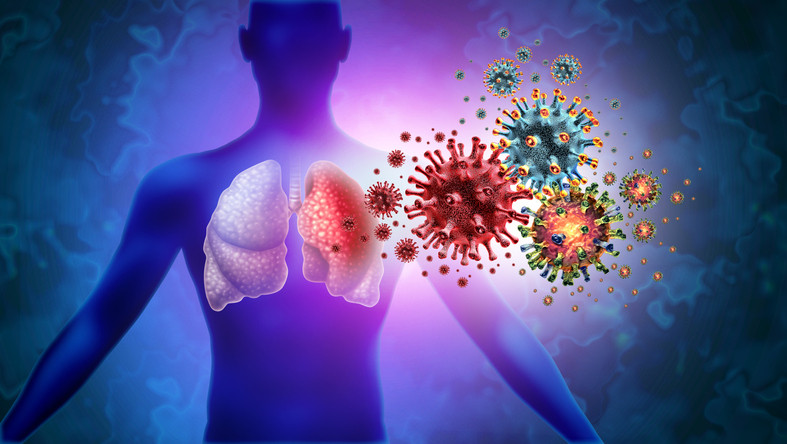 1 La neumonia es una infeccion respiratoria aguda que inflama uno o ambos pulmones y puede surgir a causa de diversos microorganismos como bacterias virus y hongos