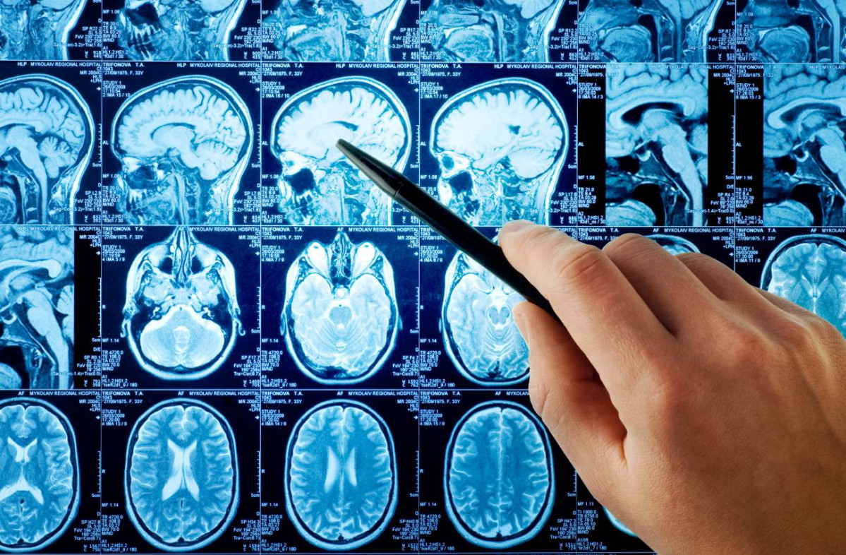 La inteligencia artificial revela variaciones en la anatomia cerebral de personas con autismo