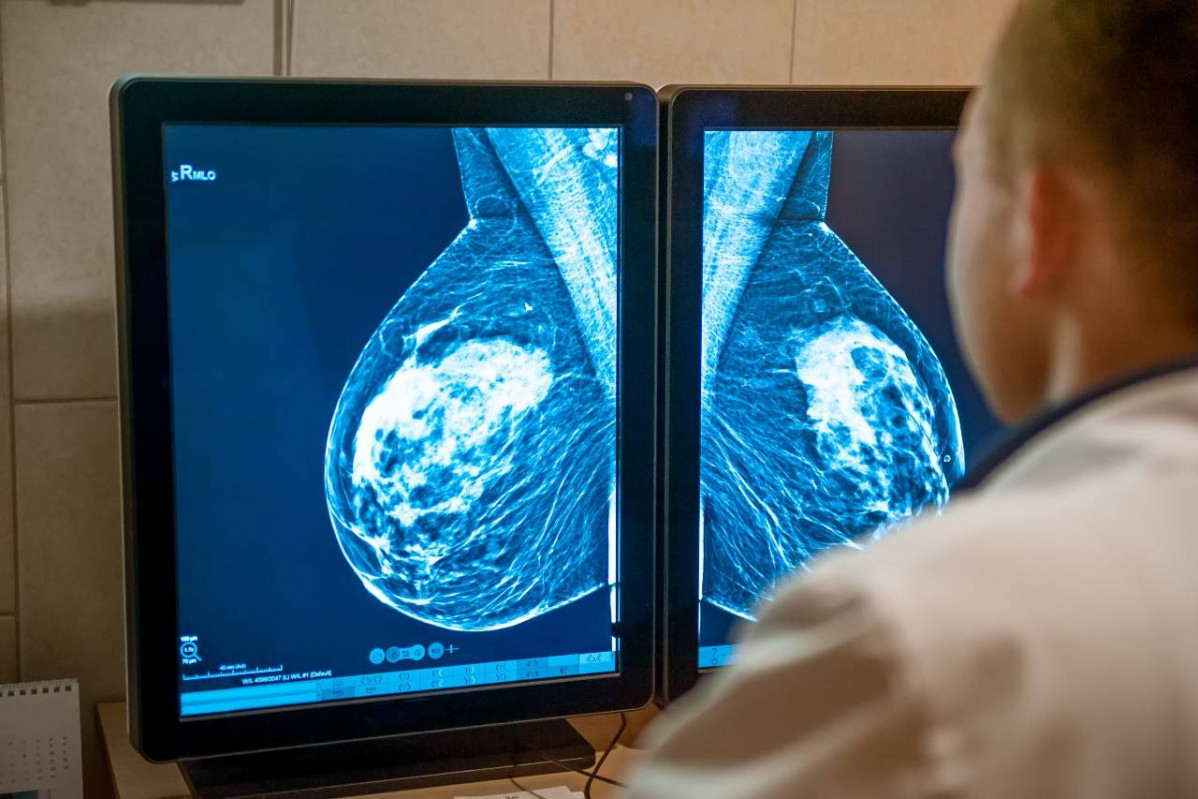 Como lograr una mayor precision en la cirugia conservadora del cancer de mama