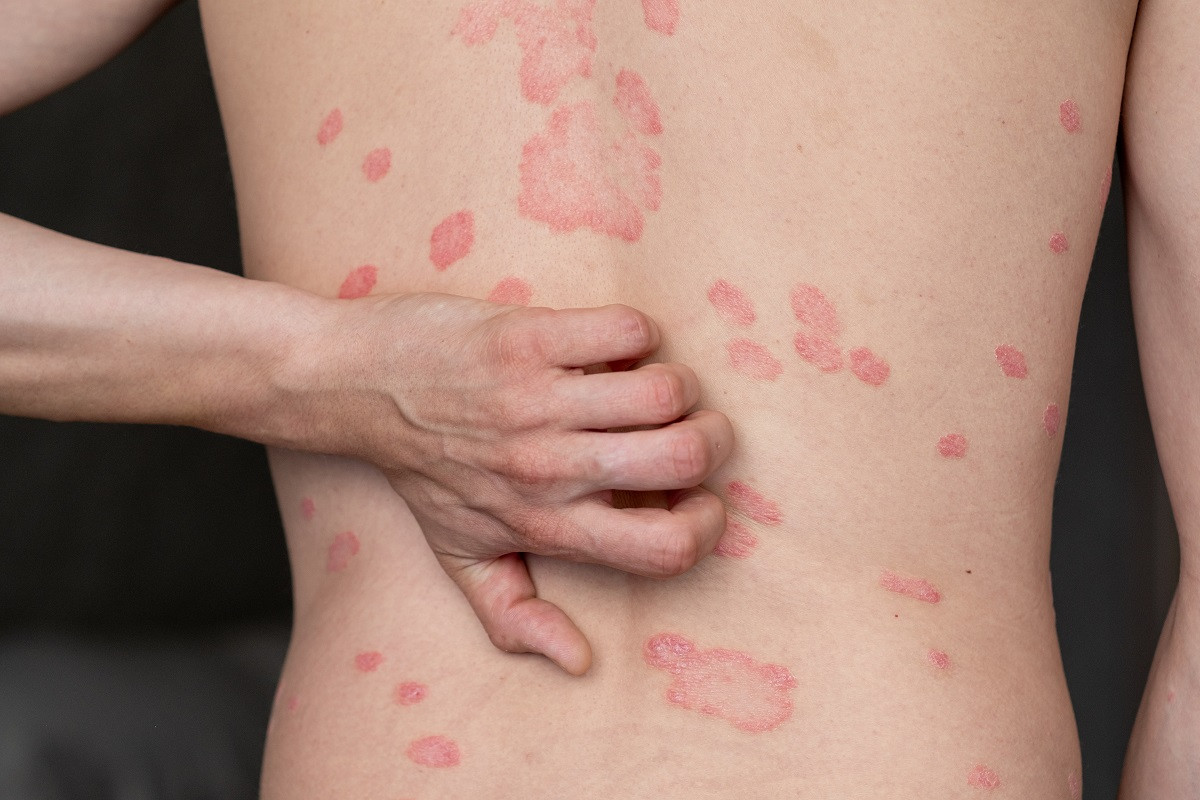 Imagen de psoriasis