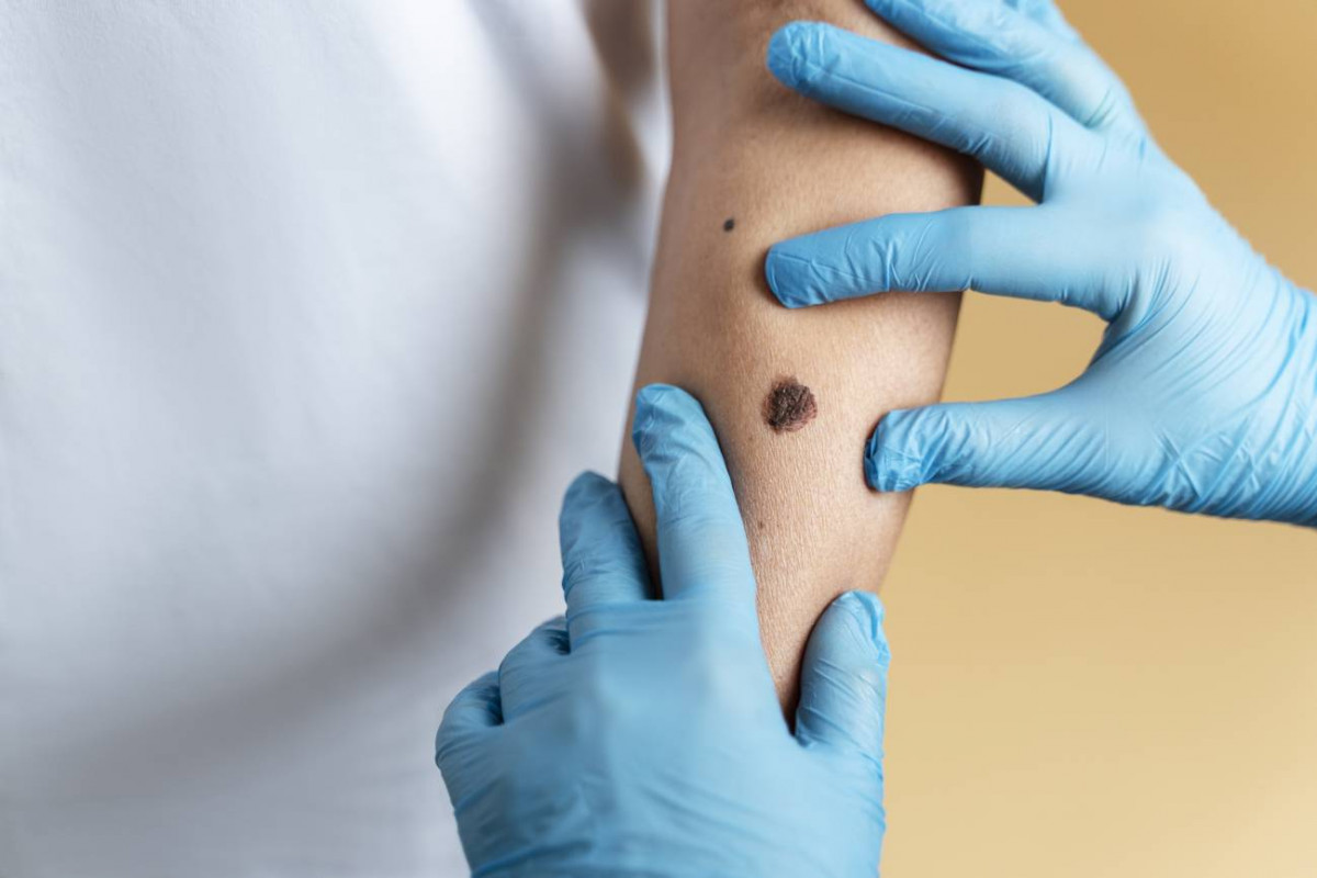 Inmunoterapia el tratamiento clave contra los melanomas